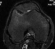 Trochlea OCD Post Patella Dislocation